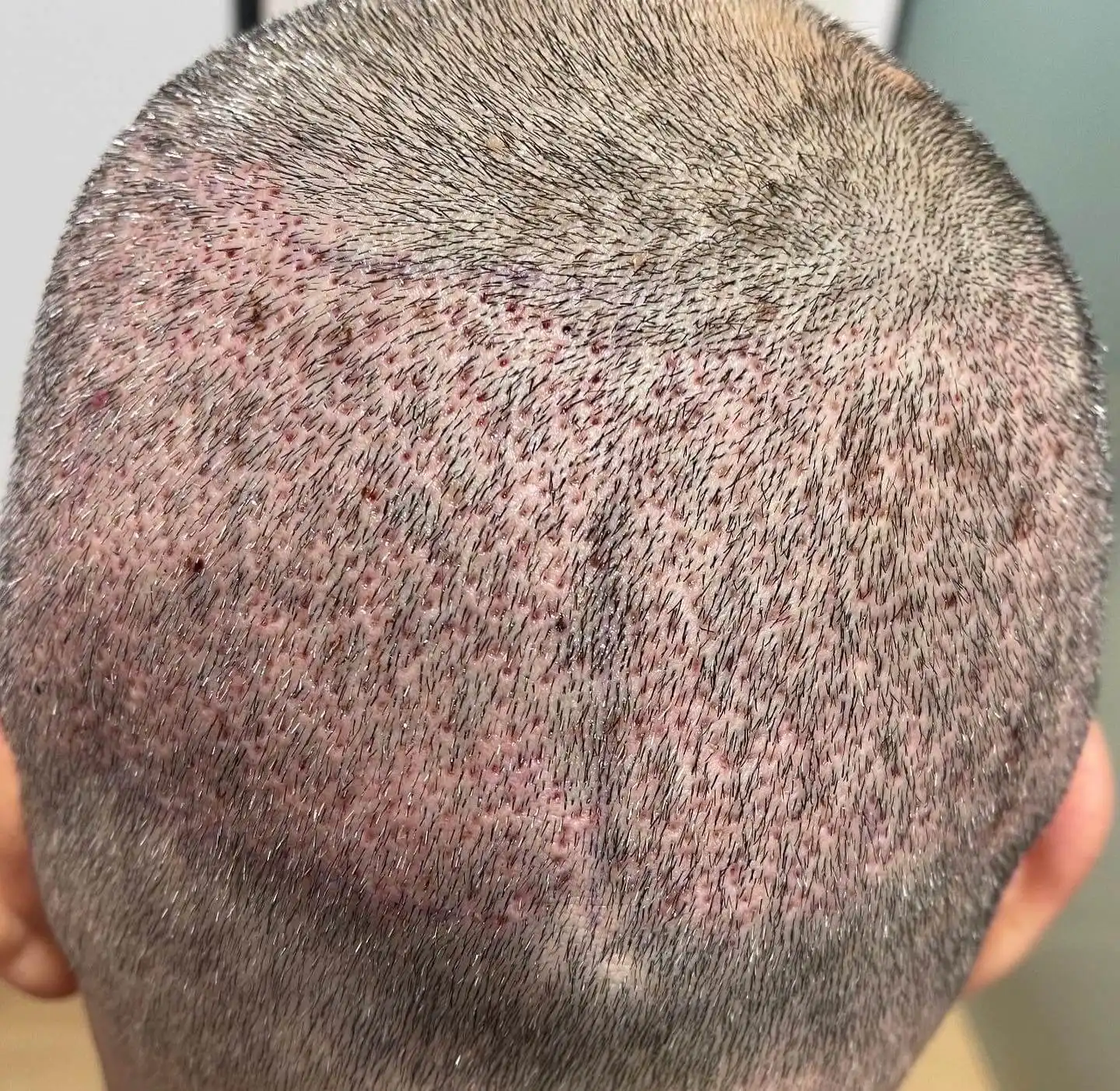 FUE Hair Transplantation