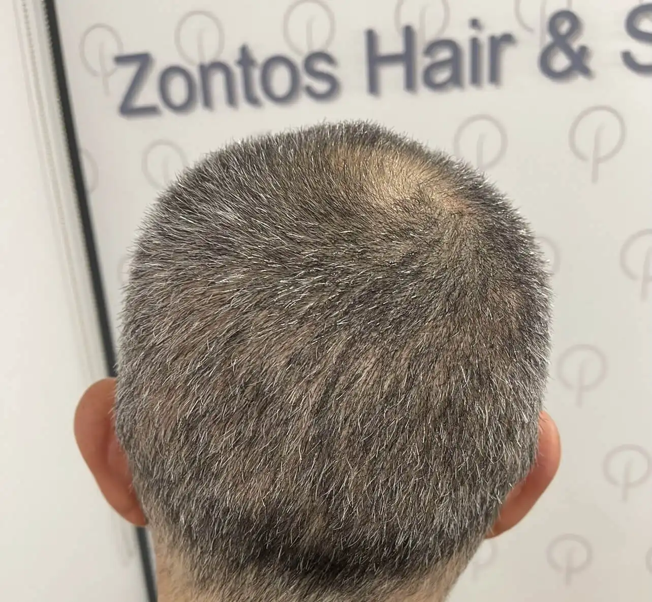 FUE Hair Transplantation