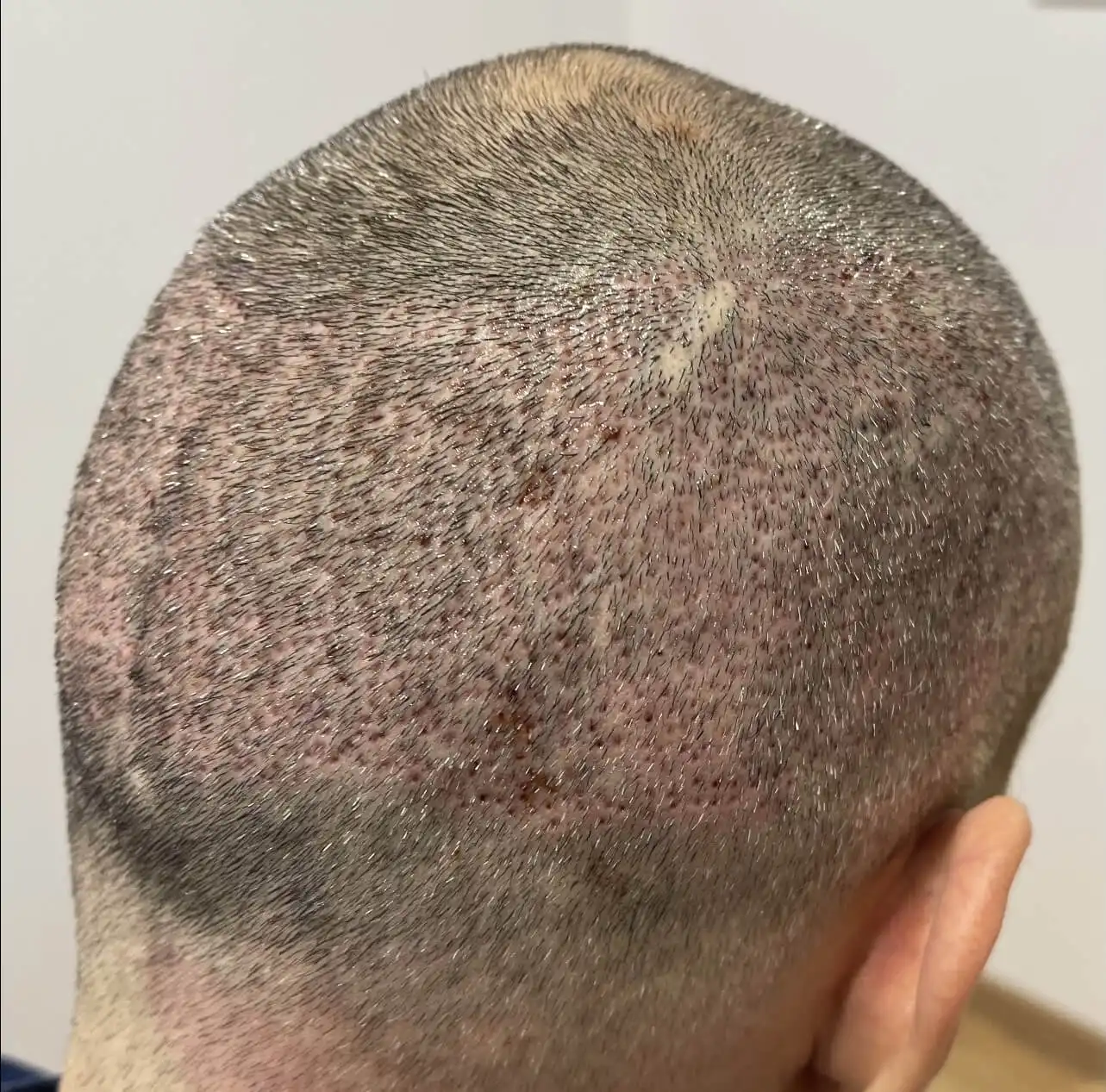 FUE Hair Transplantation