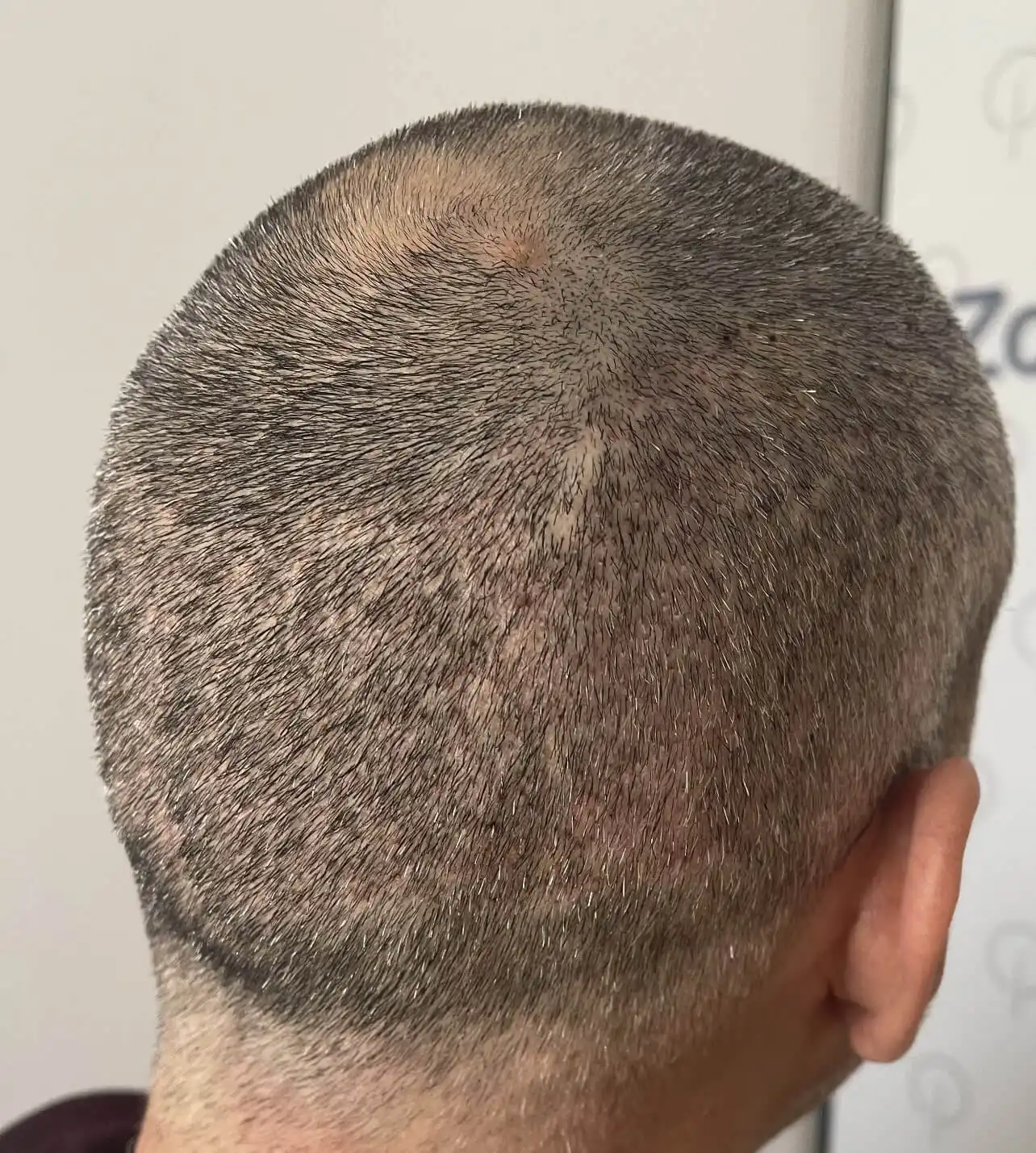 FUE Hair Transplantation