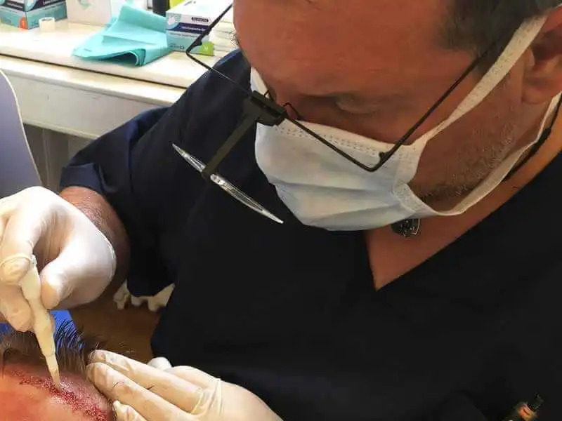 FUE Hair Transplantation