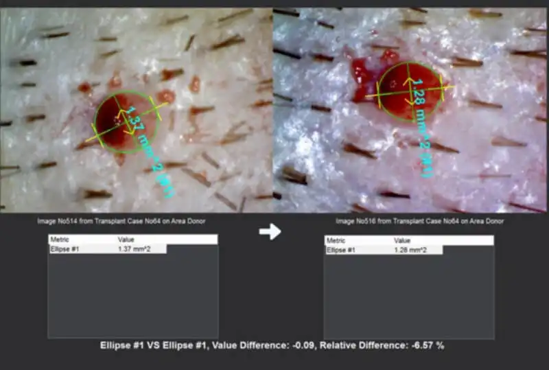 The surface of the same wound in acute extraction immediately and 3 hours later using advanced image processing reveals a 6,57 % decrease in surface of the wound.